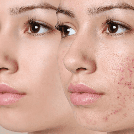 Pimple Treatments