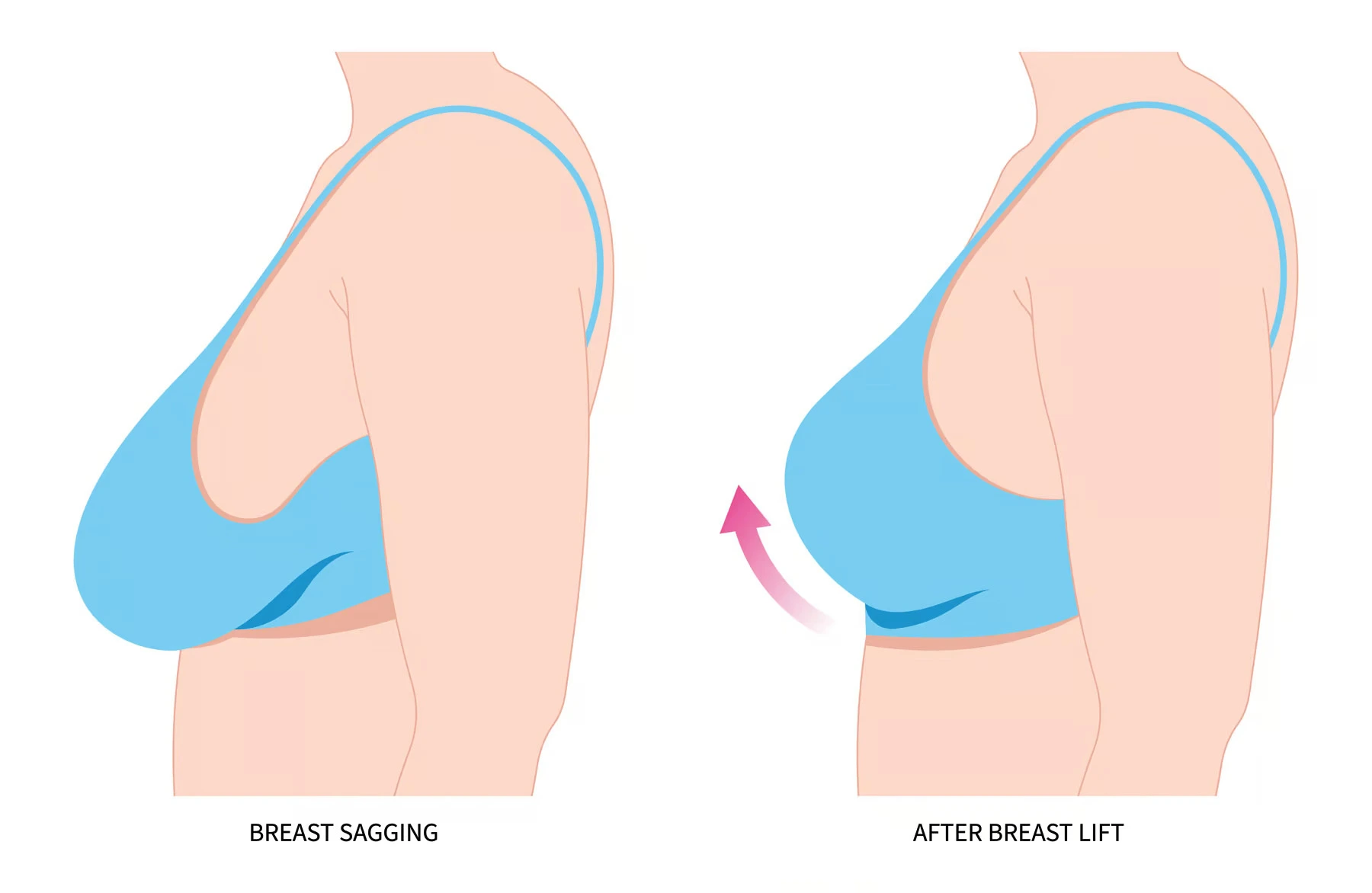 Breast Lift Surgery with Dr. Kena Patel